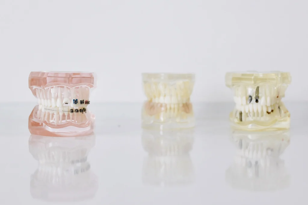 Dental models showing braces, missing teeth, and implants